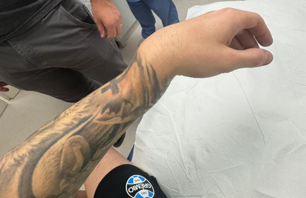 Braço do lateral-esquerdo Igor Serrote, do Grêmio, com punho fraturado após jogo contra o Godoy Cruz, pela Sul-Americana 2025